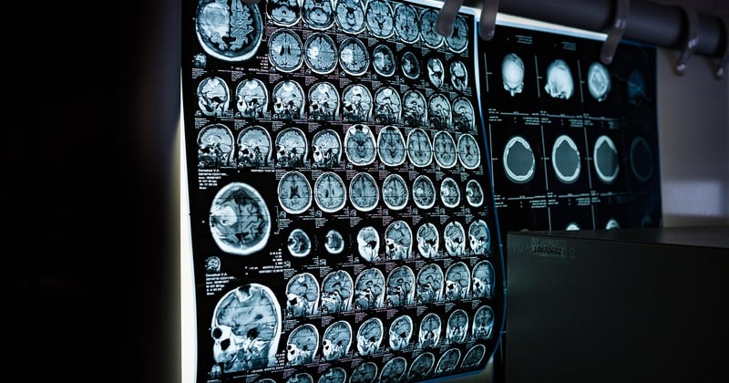 Taches blanches sur le cerveau : que signifient-elles vraiment ?